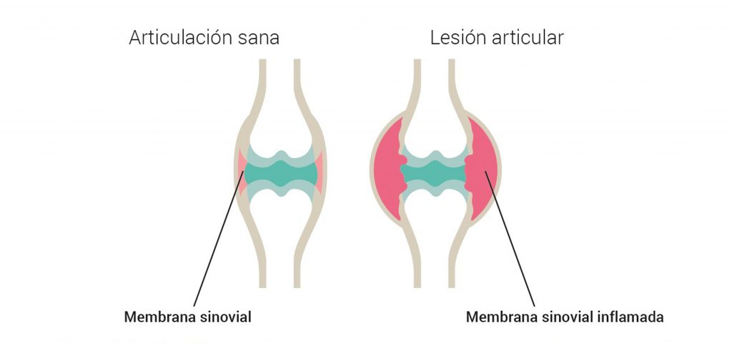 Comparación entre una articulación sana y otra con artritis.