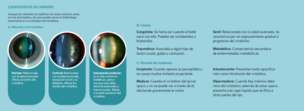 Oftalmología: clasificación de las cataratas